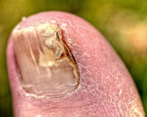 New Treatments for THICK, PAINFUL, FUNGAL Toenails.