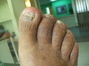 New Treatments for THICK, PAINFUL, FUNGAL Toenails.